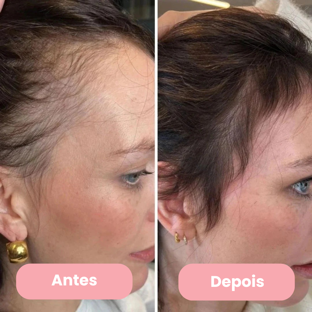 AlluHair Pró - Escova de Terapia Capilar 4 em 1.