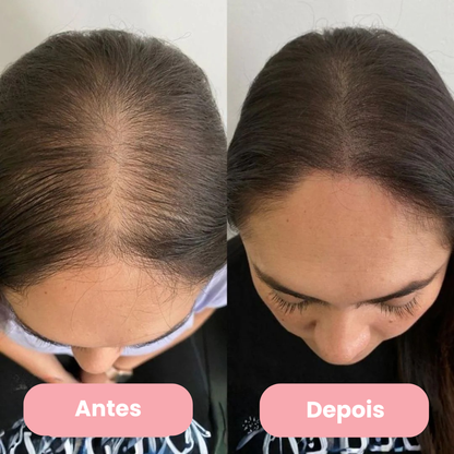 AlluHair Pró - Escova de Terapia Capilar 4 em 1.